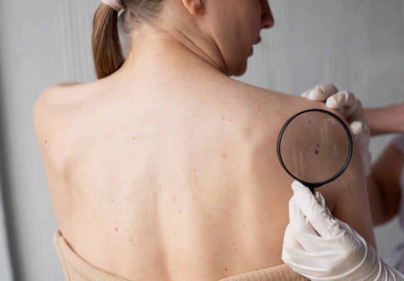 Campanha Dezembro Laranja alerta para os cuidados com o câncer de pele